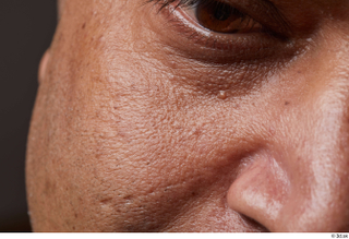 HD Face Skin Steven Hungan cheek face nose scar skin…